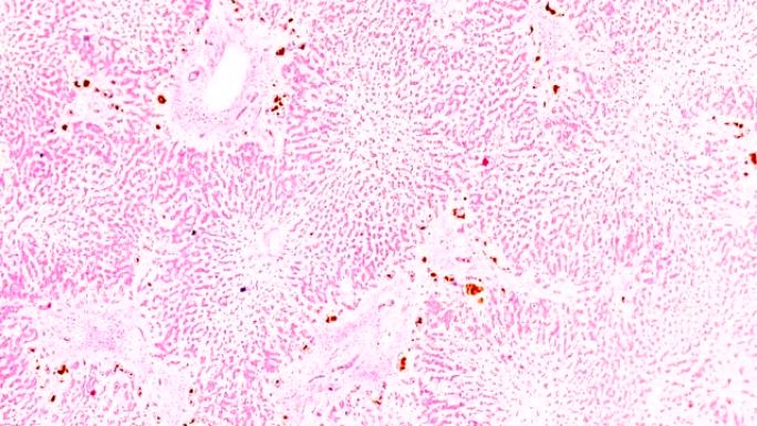 木材显微镜下急性重型肝炎