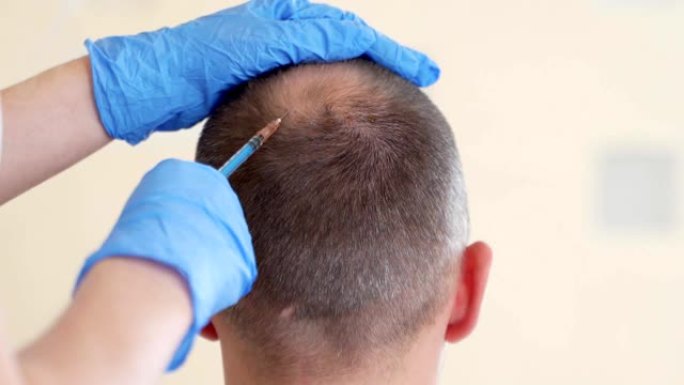 头发中胚层疗法或植发: 美容师医生在男人头部注射以促进头发生长或防止秃头