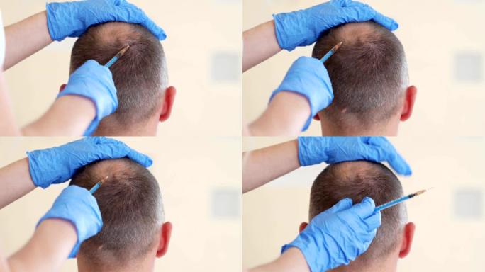 头发中胚层疗法或植发: 美容师医生在男人头部注射以促进头发生长或防止秃头