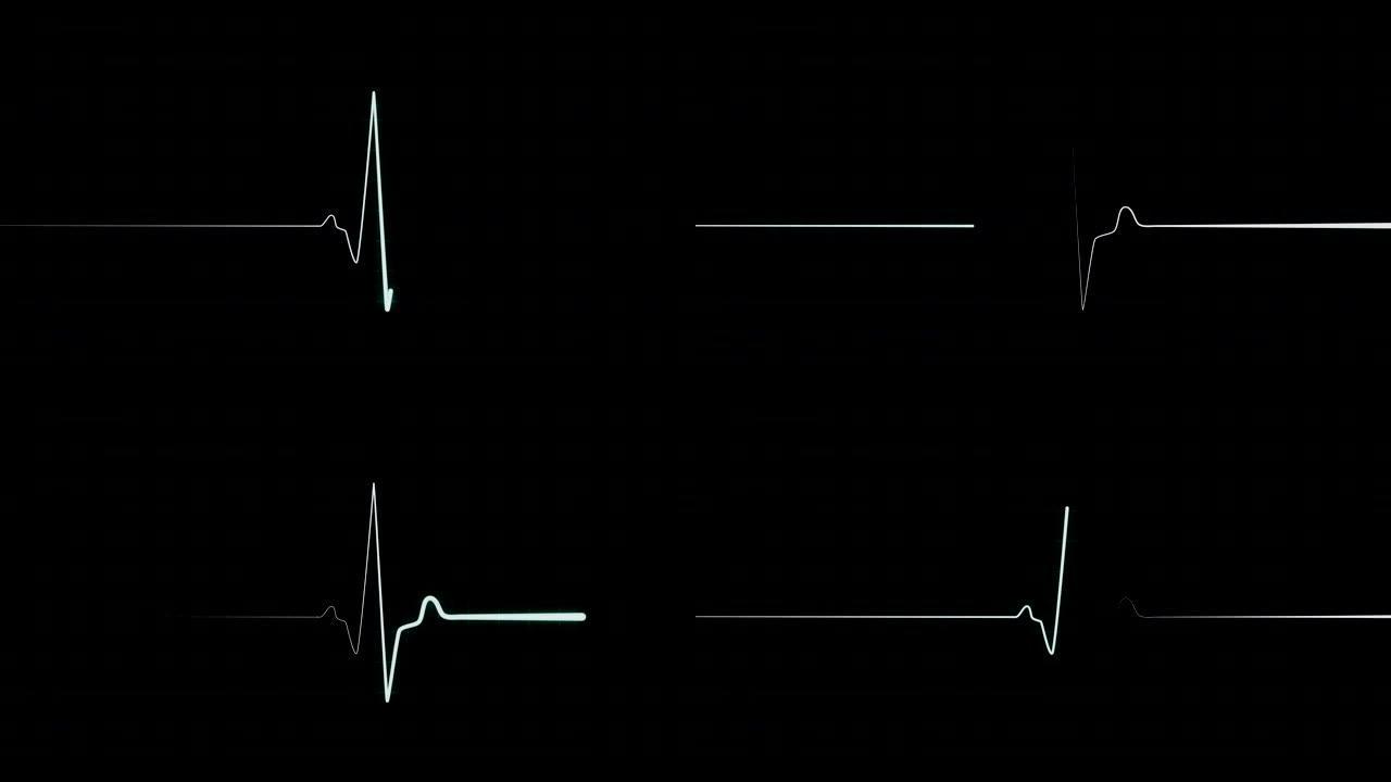 稳定心率、心电图或心电图筛查