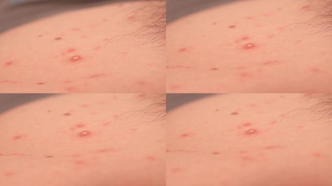 成年男性皮肤上的大皮疹或天花特写。