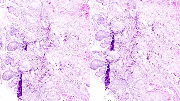 子宫颈癌 (鳞状细胞癌) 光学显微镜下放大不同区域