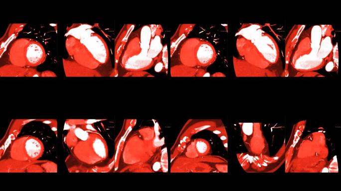 CTA冠状动脉与MIP方法比较垂直长轴，短轴和长轴视图，以检测冠状动脉疾病。