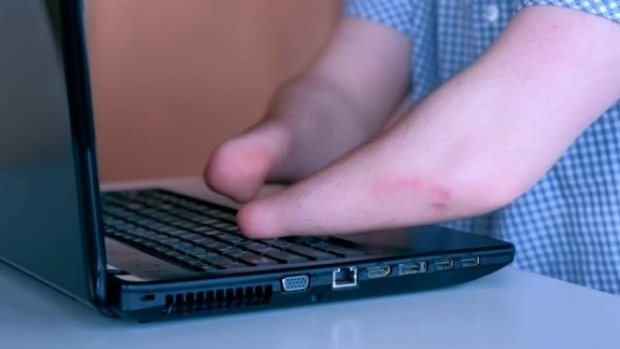 一个双手截肢的残疾人正在笔记本电脑上打字，特写。
