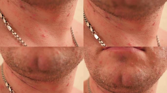 成年男性皮肤上水痘中许多红色皮疹的特写。