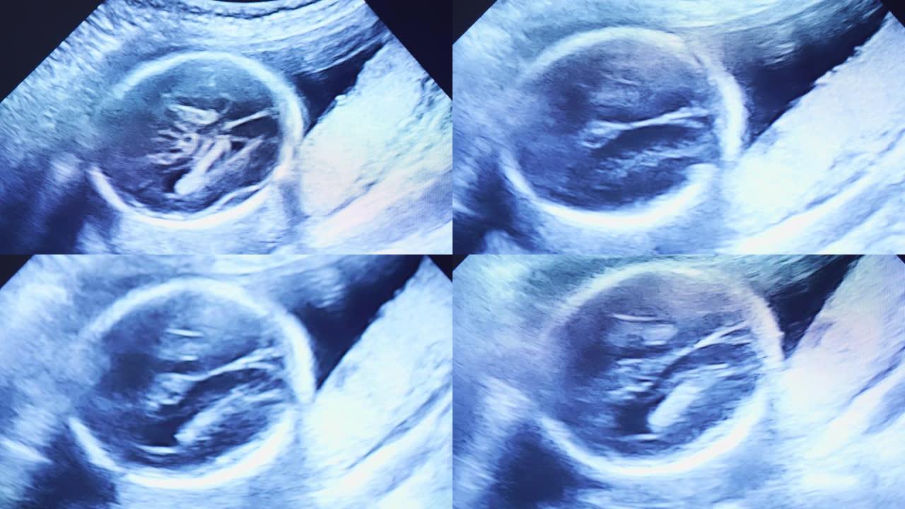 孕妇超声B超CT