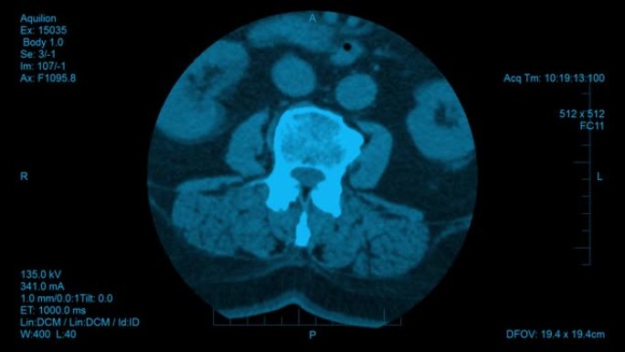 脊柱计算机断层扫描结果可视化。水平滑片的椎间盘筛查