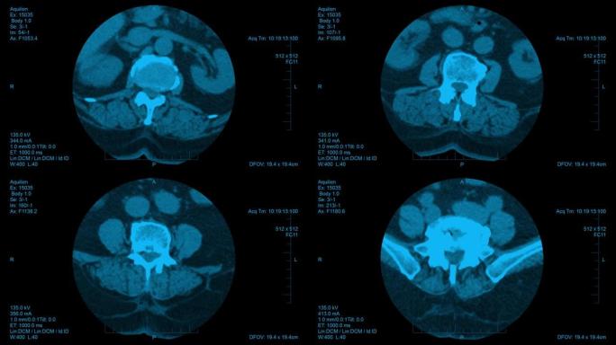 脊柱计算机断层扫描结果可视化。水平滑片的椎间盘筛查