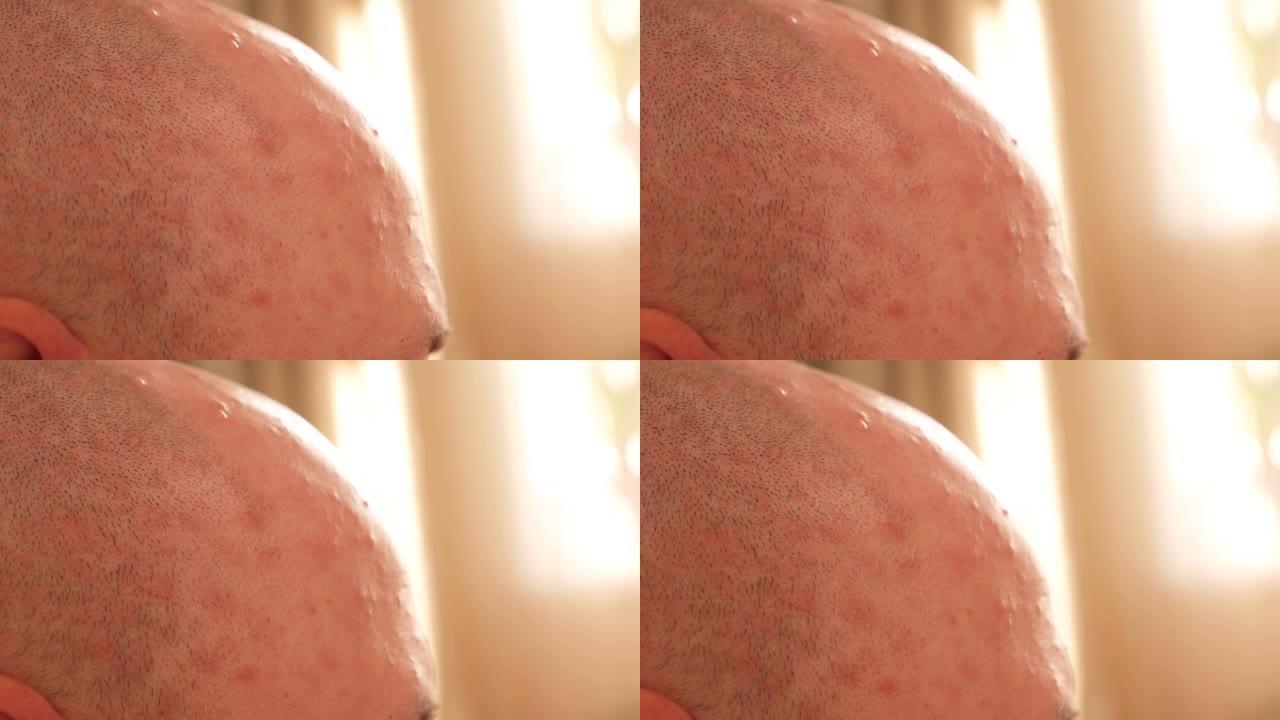 一个秃头男人的头部的特写镜头，水痘的皮肤上有皮疹。