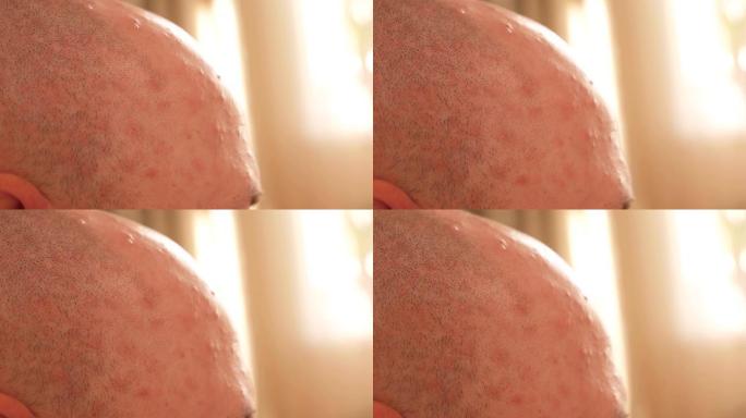 一个秃头男人的头部的特写镜头，水痘的皮肤上有皮疹。