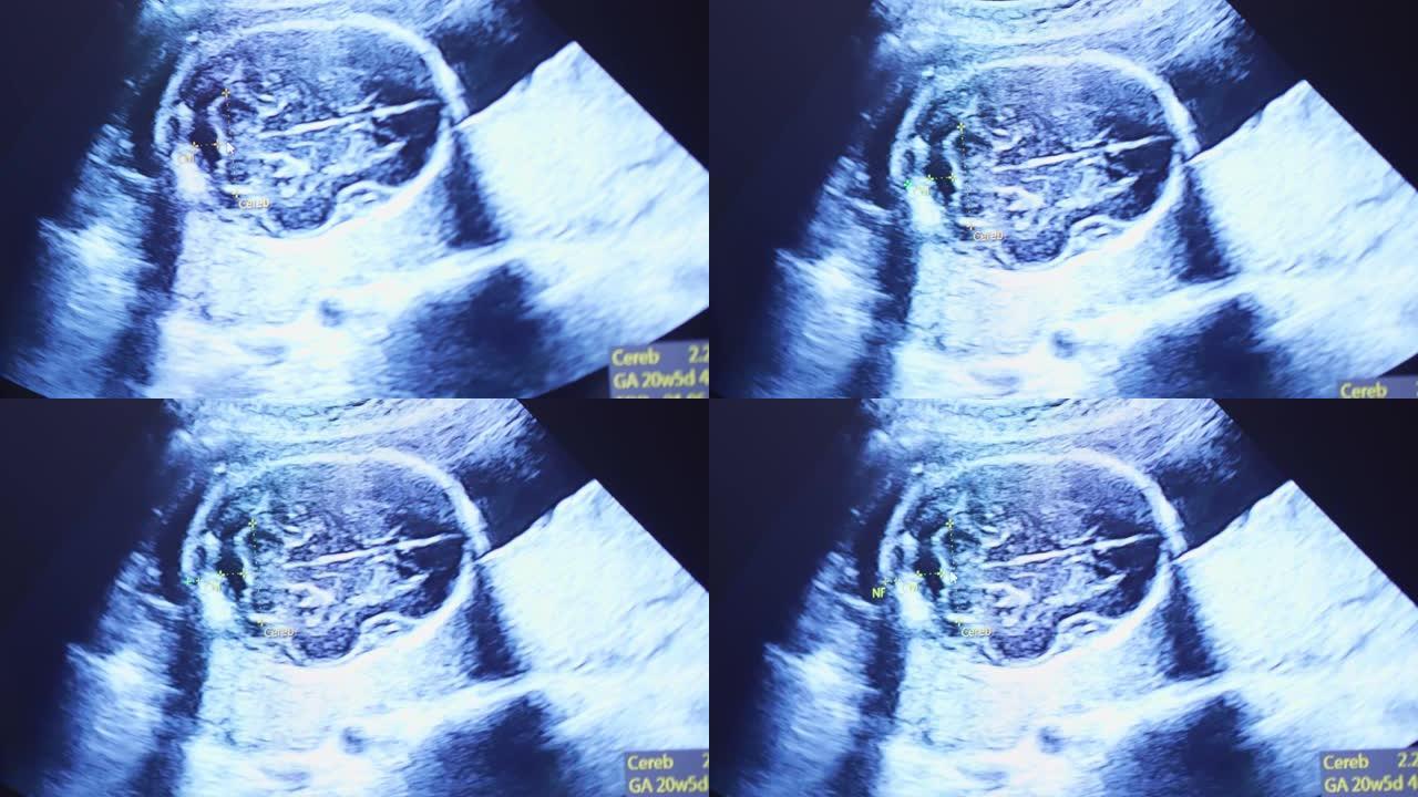 人类胚胎在超声波显示器上略微移动了他的头