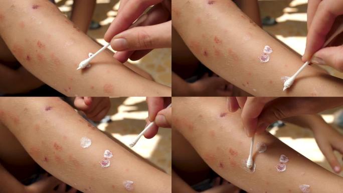使用软膏或治疗面霜治疗皮肤病