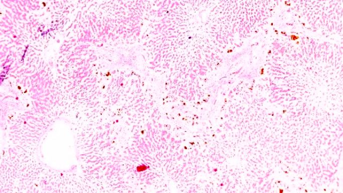 木材显微镜下急性重型肝炎