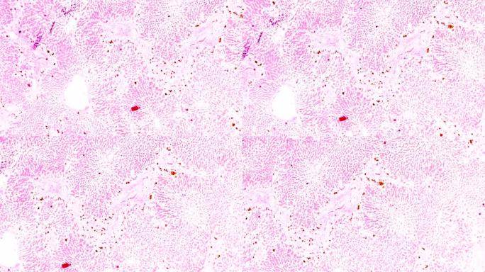 木材显微镜下急性重型肝炎