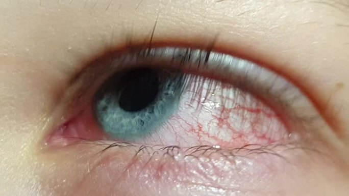 生病的眼睛特写，眼睛红肿的血管，结膜炎