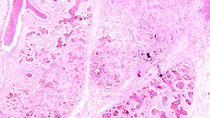 显微镜下的大叶肺炎人类病理学生物样本