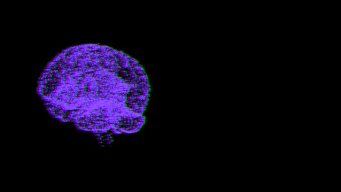 大脑神经元故障的3D动画，引起精神疾病人格障碍。
