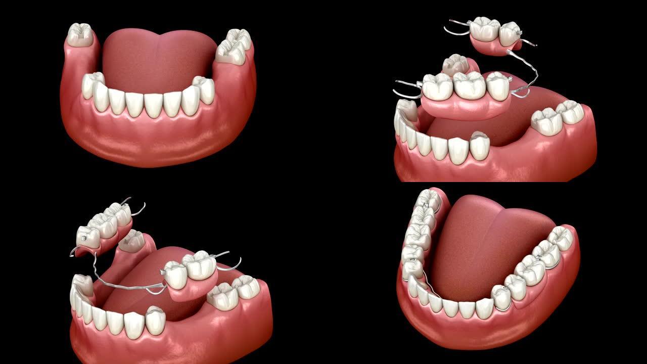 可摘局部义齿，下颌假体。口腔修复概念的医学精确3D动画