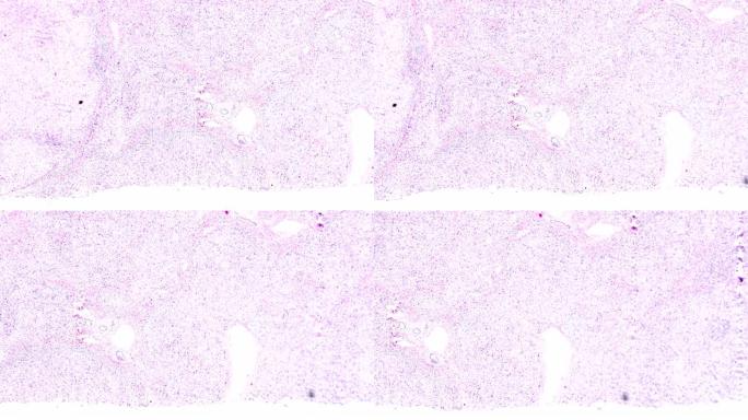 显微镜下局灶性结节性肝硬化人体病理样本