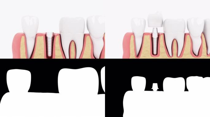 慢动作闭合断面处理种植牙。3D动画。4K