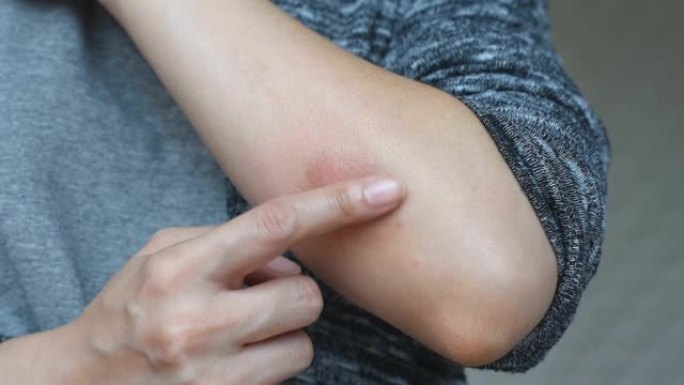皮肤过敏性疾病问题，特应性皮炎皮疹的治疗，女性皮肤科患者手臂过敏性湿疹，银屑病因虚弱而复发，不健康。