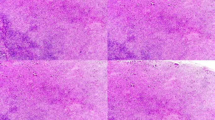 显微镜下的非霍奇金淋巴瘤在不同范围内缩放