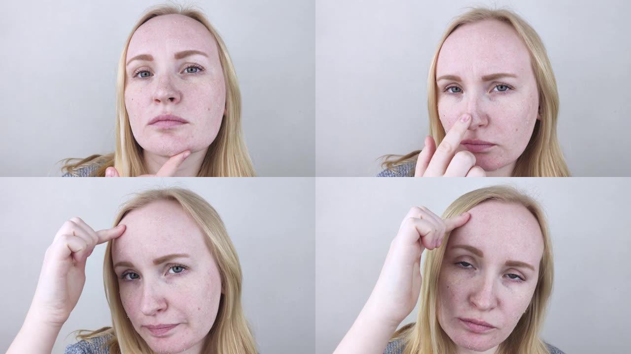 一位妇女在检查她脸上干燥的皮肤。脱皮、变粗、不适、皮肤敏感。患者可预约皮肤科医生或美容师，选择适合干