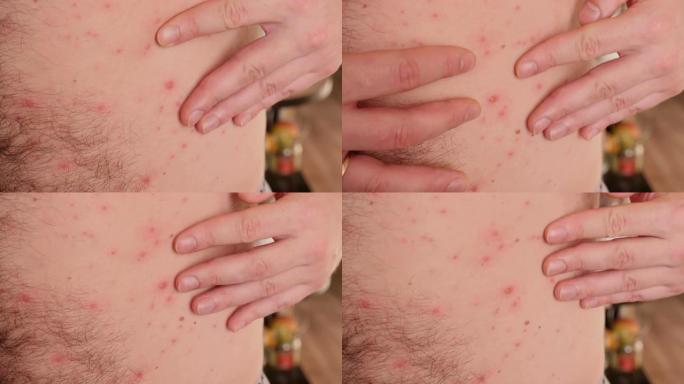 成年男性的水痘在皮肤上发痒。
