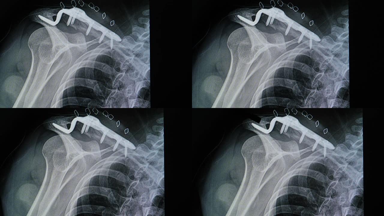 金属板和螺钉固定后锁骨骨折患者的x光片