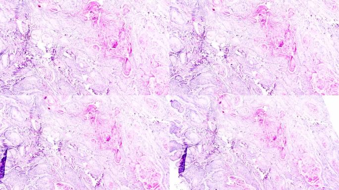 子宫颈癌 (鳞状细胞癌) 光学显微镜下放大不同区域