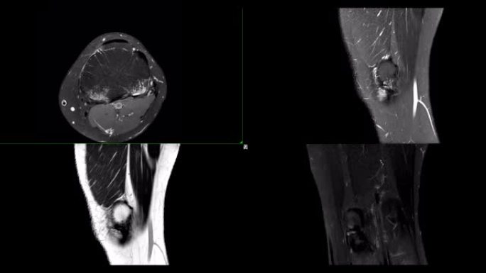 比较MRI膝关节或磁共振成像膝关节stir技术的轴向、矢状面和冠状面凹陷t2。