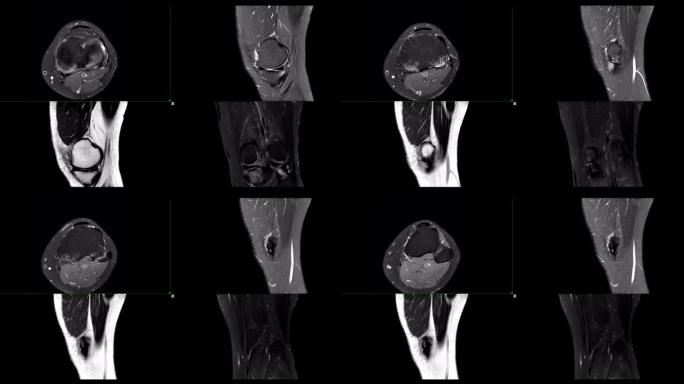 比较MRI膝关节或磁共振成像膝关节stir技术的轴向、矢状面和冠状面凹陷t2。