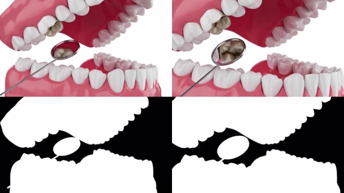 慢动作特写用嘴镜3D动画用阿尔法伴侣腐烂的牙齿。4K