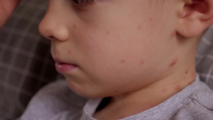 一个小孩脖子上有一个非常大的水痘水泡的特写镜头。