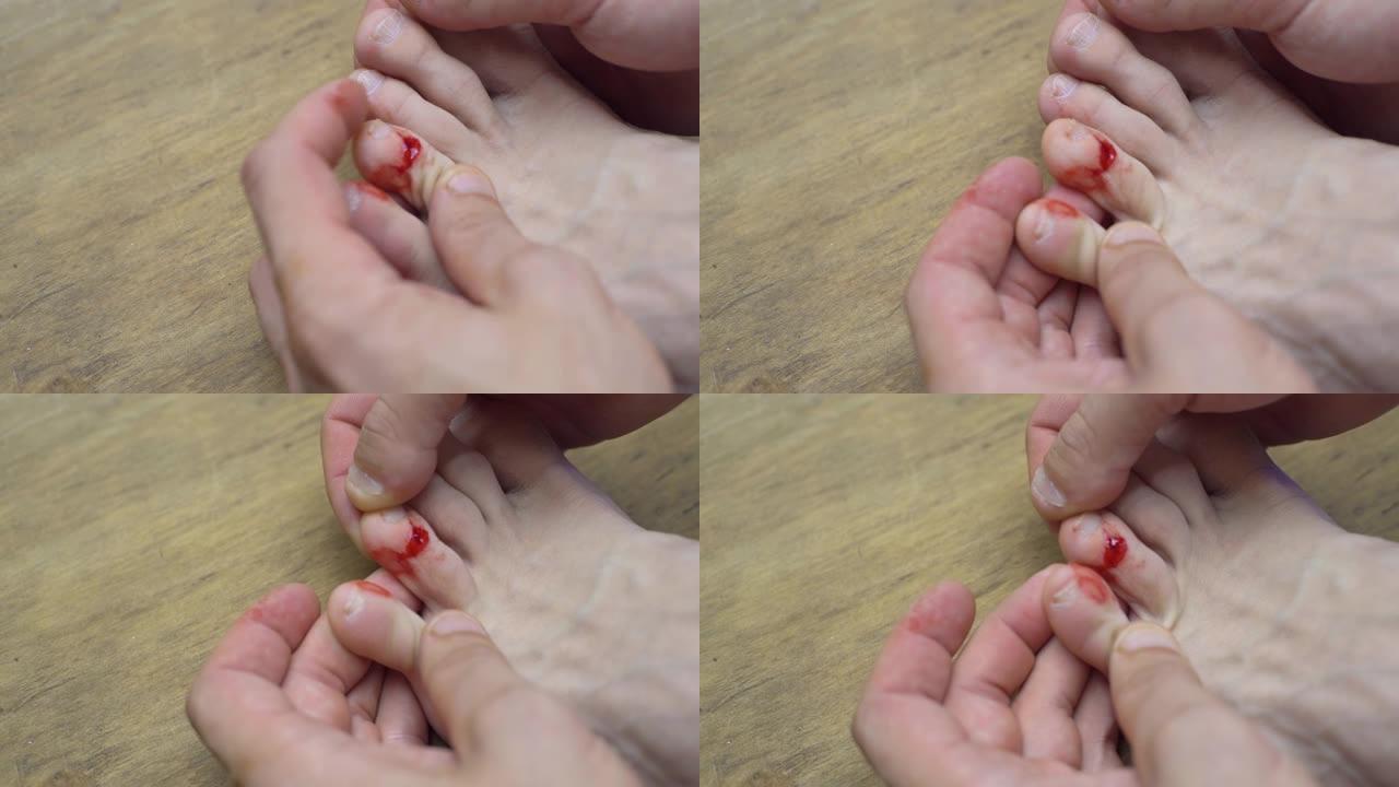 干净伤口的特写。人左脚的手指被割伤得很痛苦。