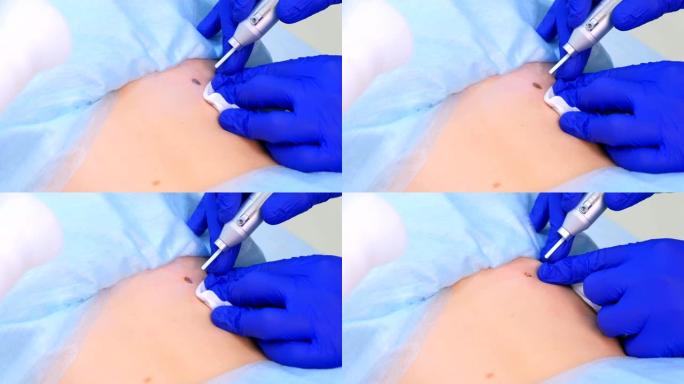 医生外科医生用激光束清除病人背部的痣，特写视图。