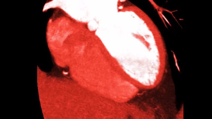 用MIP方法检测冠状动脉疾病的CTA冠状动脉长轴视图。