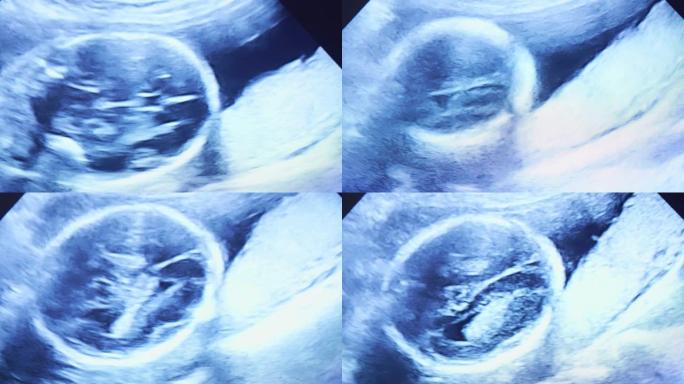 人类胚胎在超声波显示器上略微移动了他的头