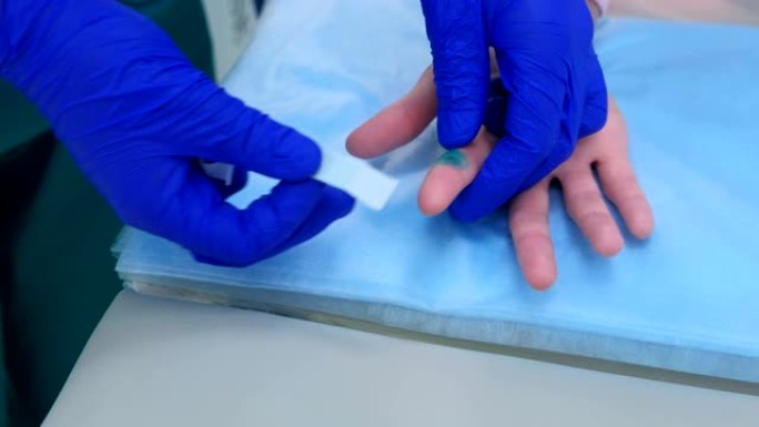 外科医生在去除疣后用石膏封住患者的手指，双手特写。