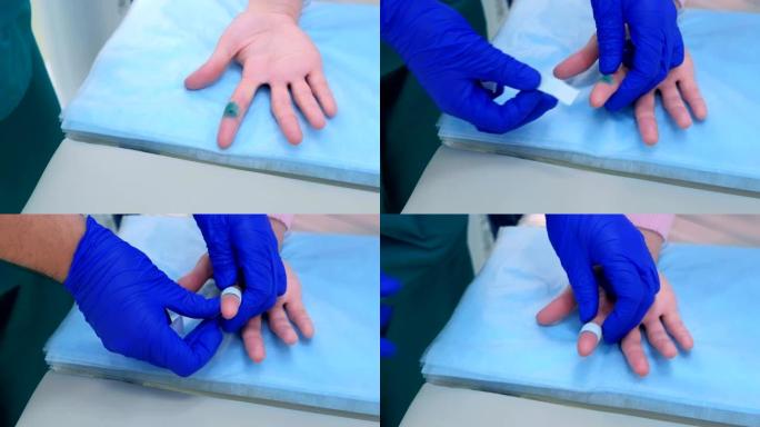 外科医生在去除疣后用石膏封住患者的手指，双手特写。