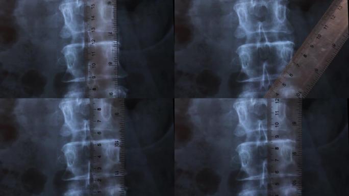 人体脊柱骨骼的x射线