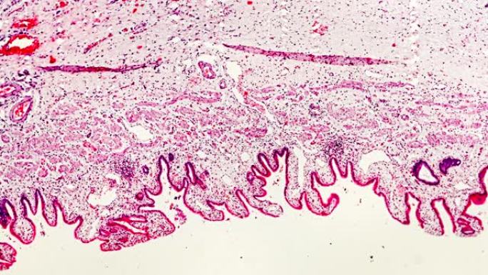 显微镜下的慢性胆囊炎人体病理样本