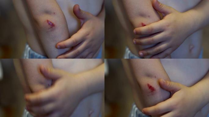 一个小孩手上有血的抓痕特写。