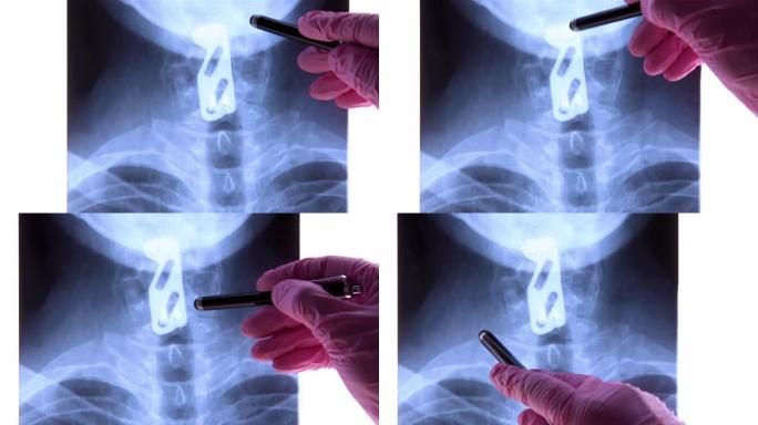 医生分析钛板支撑颈椎的x线摄影