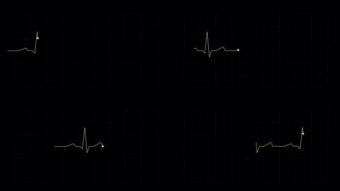 监视器上的心电图图像。