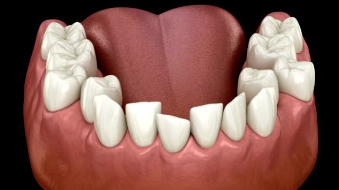 过度拥挤的牙齿闭塞 (牙齿咬合不正)。医学上精确的牙齿3D动画