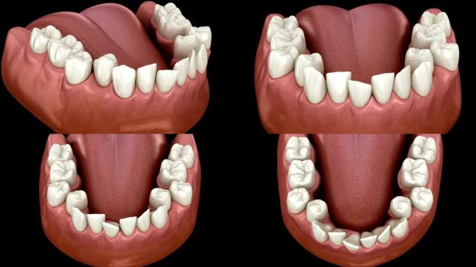 过度拥挤的牙齿闭塞 (牙齿咬合不正)。医学上精确的牙齿3D动画