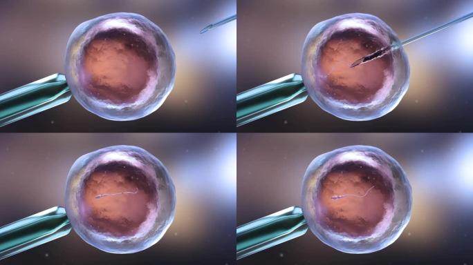 人工授精或体外受精