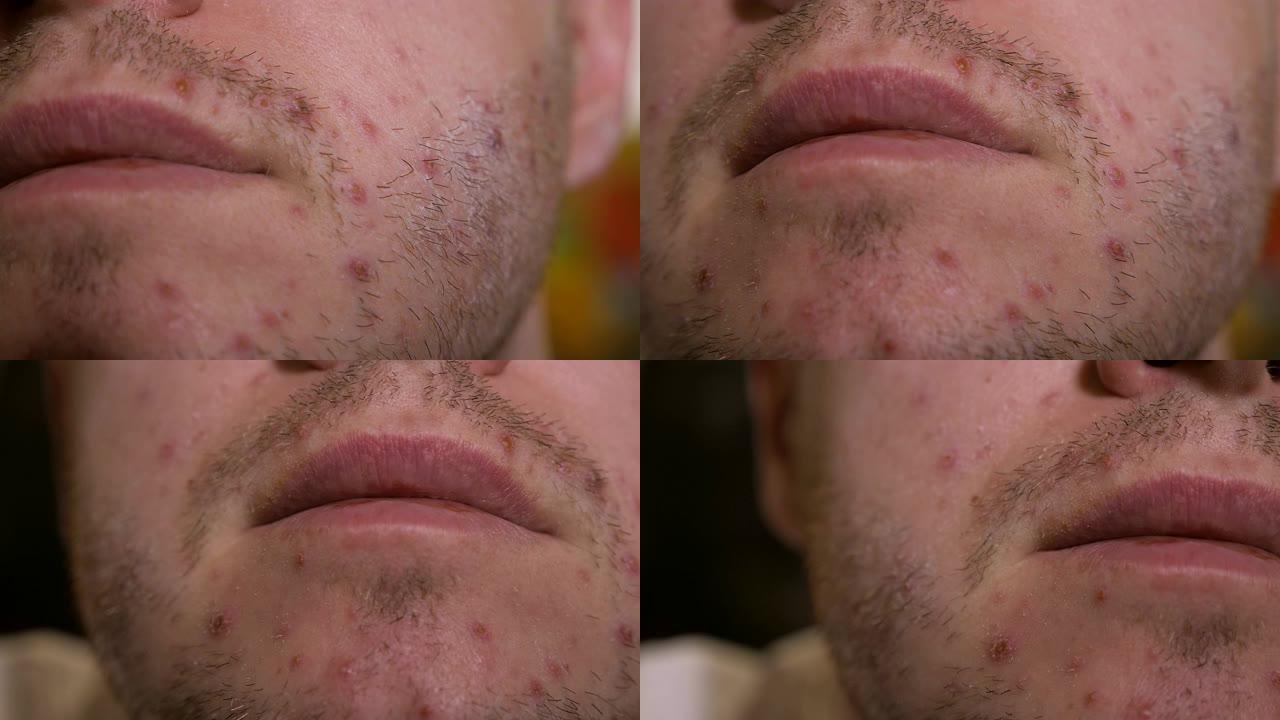 成年男性的脸上和胡须上有许多红色的皮疹和痘印。水痘