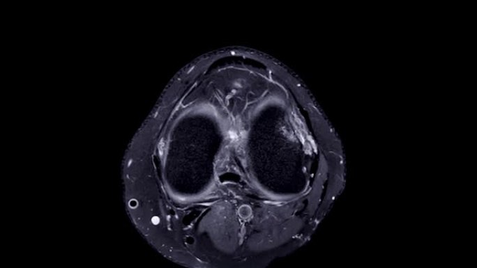 MRI膝关节或磁共振成像膝关节轴向stir视图。